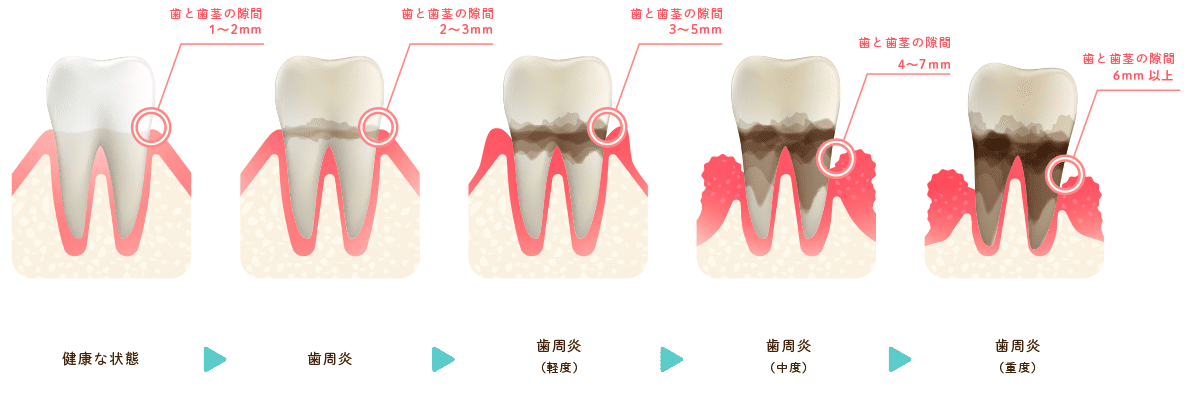歯周病の進行段階