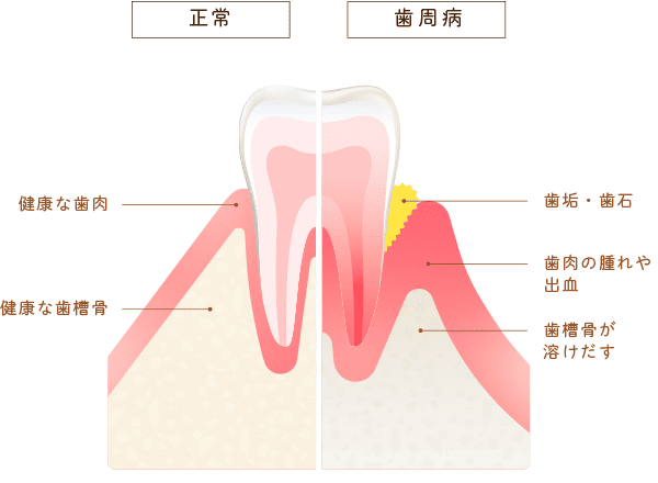 健康な歯と歯周病の歯